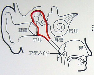 急性中耳炎