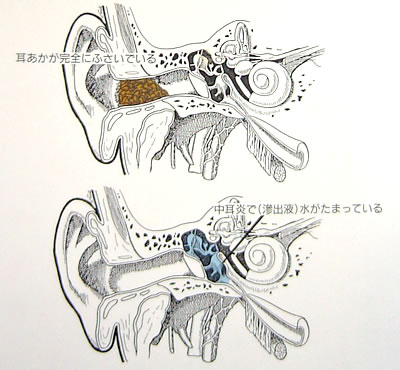 年のせいとあきらめないで、一度は耳鼻科をおとずれて下さい。