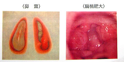 いびきを大きくする要因